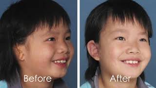 What Is Microtia [upl. by Ken]