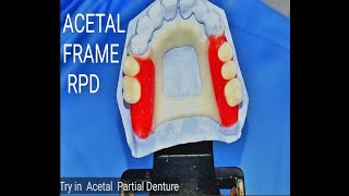 Try in Acetal Removable Partial Denture [upl. by Alarice125]