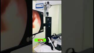 How to interpret tympanic membrane examination  DDS Traumatic perforation AOM like subscribe [upl. by Nikaniki125]