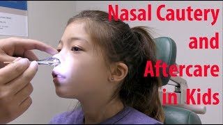 Pediatric Nosebleed Cauterization and Aftercare [upl. by Rothberg]