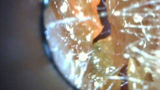 Ear Wax Removal Causing a strange noise not tinnitus [upl. by Marquita]