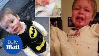 Boy has genetic disorder causing his skin to blister when touched [upl. by Aerdnaxela150]