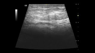 Spermatic Cord Lipoma  Ultrasound Case  GU [upl. by Nine]