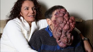 10 People with Extreme Deformities [upl. by Atinat613]