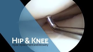 The Procedure  Arthroscopy [upl. by Noraa]