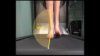 Over Pronation and how this is measured in walking [upl. by Shulman434]