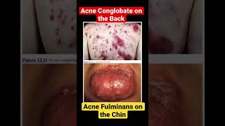 Acne Conglobate on the Back  Acne fulminans on the chin [upl. by Ahseral]