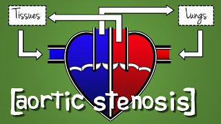 Aortic Stenosis EXPLAINED with Animation [upl. by Eissahc]