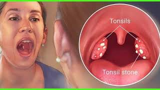 How To Diagnose Tonsillitis Physical Examination For Tonsillitis [upl. by Graves357]