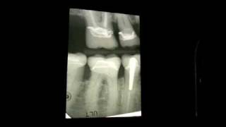 Xrays of Decayed Teeth [upl. by Aicilana]