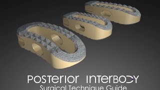 Posterior Interbody Surgical Technique Guide [upl. by Alaik]