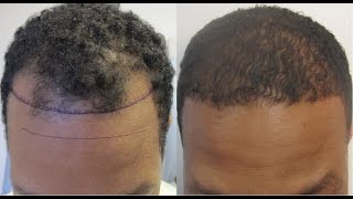 Hair Regrowth for Men Naturally [upl. by Llemert946]