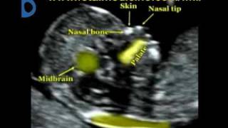 Fetal Medicine Foundation  Nuchal translucency [upl. by Bender]