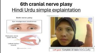 6th cranial nerve palsy in hindi urdu  simple explaintation  cranialnerves plasy [upl. by Magdalen]