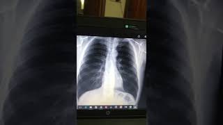 Pleural Effusion Final prof Xray interpretation [upl. by Roshan]