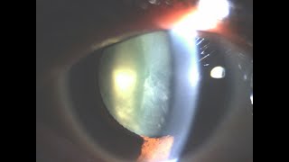 soft cortical cataract synergy IOL with tension ring [upl. by Siwel441]