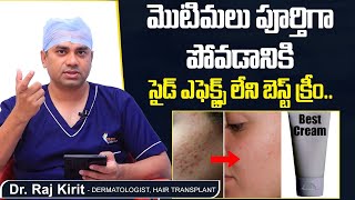 మొటిమలకు బెస్ట్ క్రీం  Best Cream for Pimples Without Side Effects  Celestee Skin And Hair Clinic [upl. by Adena]