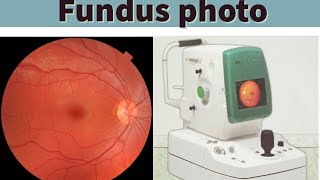 Fundus photography fundus camera [upl. by Bessy]