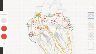 Cardiología y ECG Taquicardias supraventriculares vs ventriculares [upl. by Rahr]