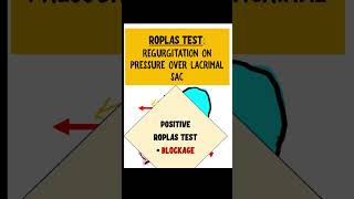 ROPLAS TEST dacryocystitis opthalmology [upl. by Tterab]