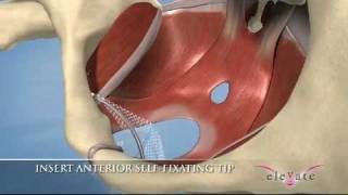 elevate  Anterior amp Apical Prolaps Repair System  Surgical and animated procedural video [upl. by Rustin393]