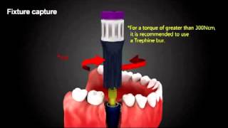 Implant Fixture Removal Technique from Bone 911 Removal Kit [upl. by Armil484]