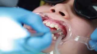 Braces Putting Braces On Bonding Procedure  Aura Orthodontics [upl. by Enom]