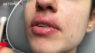 Ferulac Dubai Lips Peel  ASTOMED klinikutrustning [upl. by Auof]