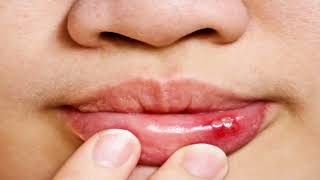 Difference Between Cold Sore and Herpes [upl. by Joella]