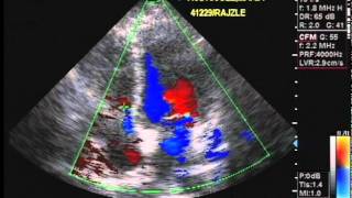 Echocardiography and Color Flow Doppler [upl. by Alegnad]