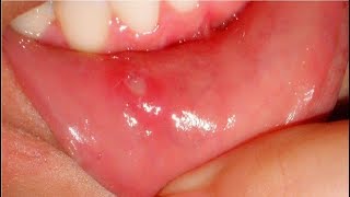 how to get rid of canker sores in minutes [upl. by Dickerson]