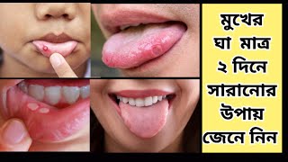 মাত্র ২ দিনে মুখের ঘা সারানোর উপায় জেনে নিন  How to get rid of mouth ulcer in 2 days [upl. by Jarnagin]