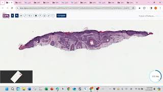 Tumor of follicular infundibulum [upl. by Assener]