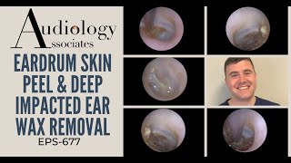 EARDRUM SKIN PEEL amp DEEP IMPACTED EAR WAX REMOVAL  EP677 [upl. by Derick]