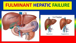 FULMINANT HEPATIC FAILURE [upl. by Charo]