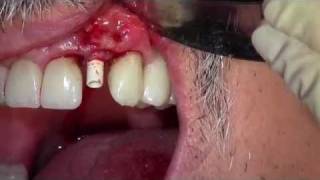 Klipod Recording of Dental Implant Surgery  10 legacy [upl. by Lara925]