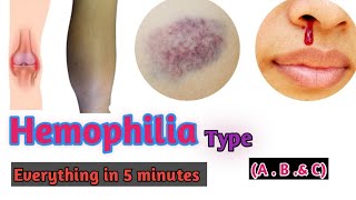 Hemophilia  Hemophilia types  Hemophilia A  Hemophilia B Hemophilia C Doctors goal [upl. by Ennahteb]