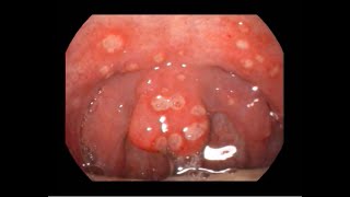 Acute Ulcerative Pharyngitis Causing Severe Sorethroat [upl. by Nannah]