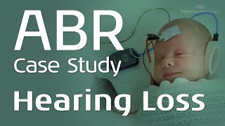 ABR Case Study Sensorineural Hearing Loss [upl. by Neyud]