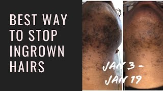 How To STOP Ingrown Hair  Ingrown Hair Prevention TIPS and Tricks [upl. by Ainerbas]