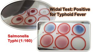 Widal Test Positive Demonstration [upl. by Eadas531]