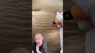 Plasma Pen As A Cure For Stretchmarks  Doctor Reacts [upl. by Sidoney378]