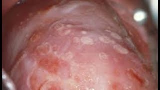 genital herpes treatment [upl. by Nyrmac472]