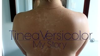 Tinea Versicolor Part 1  TNBeauty94 [upl. by Suivart]