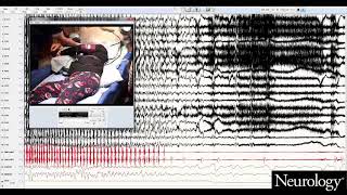 Postconvulsive central apnea as a biomarker for sudden unexpected death in epilepsy SUDEP 2 [upl. by Nais]