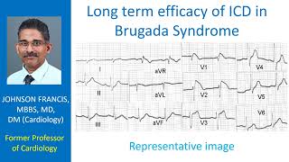 Long term efficacy of ICD in Brugada Syndrome [upl. by Ttebroc]