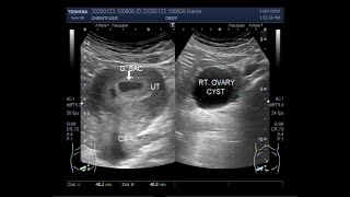 Early Pregnancy of about 45 weeks with an Ovarian Cyst [upl. by Mccreery]