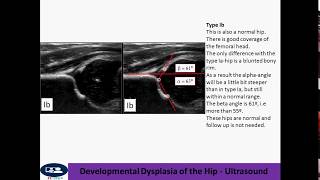 Developmental Dysplasia of the Hip  Ultrasound [upl. by Aluin]