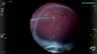 PPV for retinal detachment with large breaks and some previous prophilactic laser treatment [upl. by Adiela39]