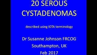 serous cystadenomas YouTube Feb 2017 [upl. by Mendel626]